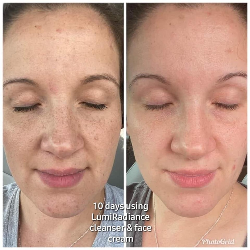 Problemas con manchas en tu rostro?